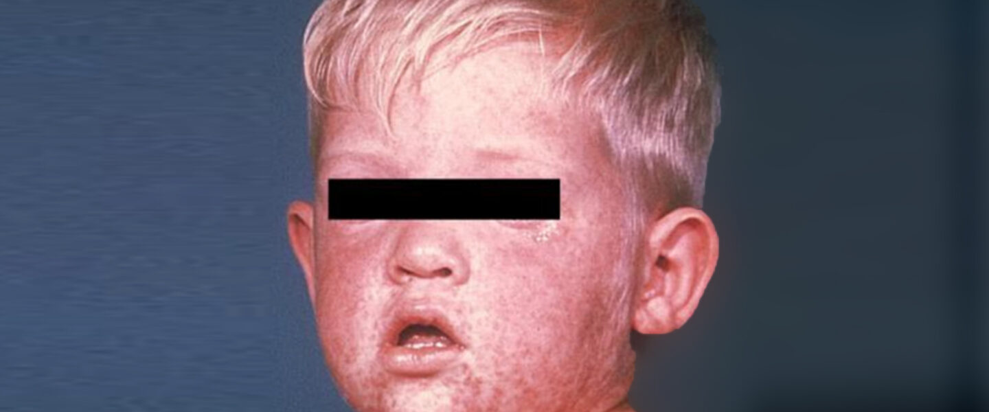 measles, blemishes